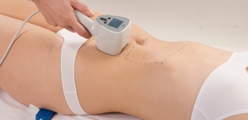 stretch mark removal treatment